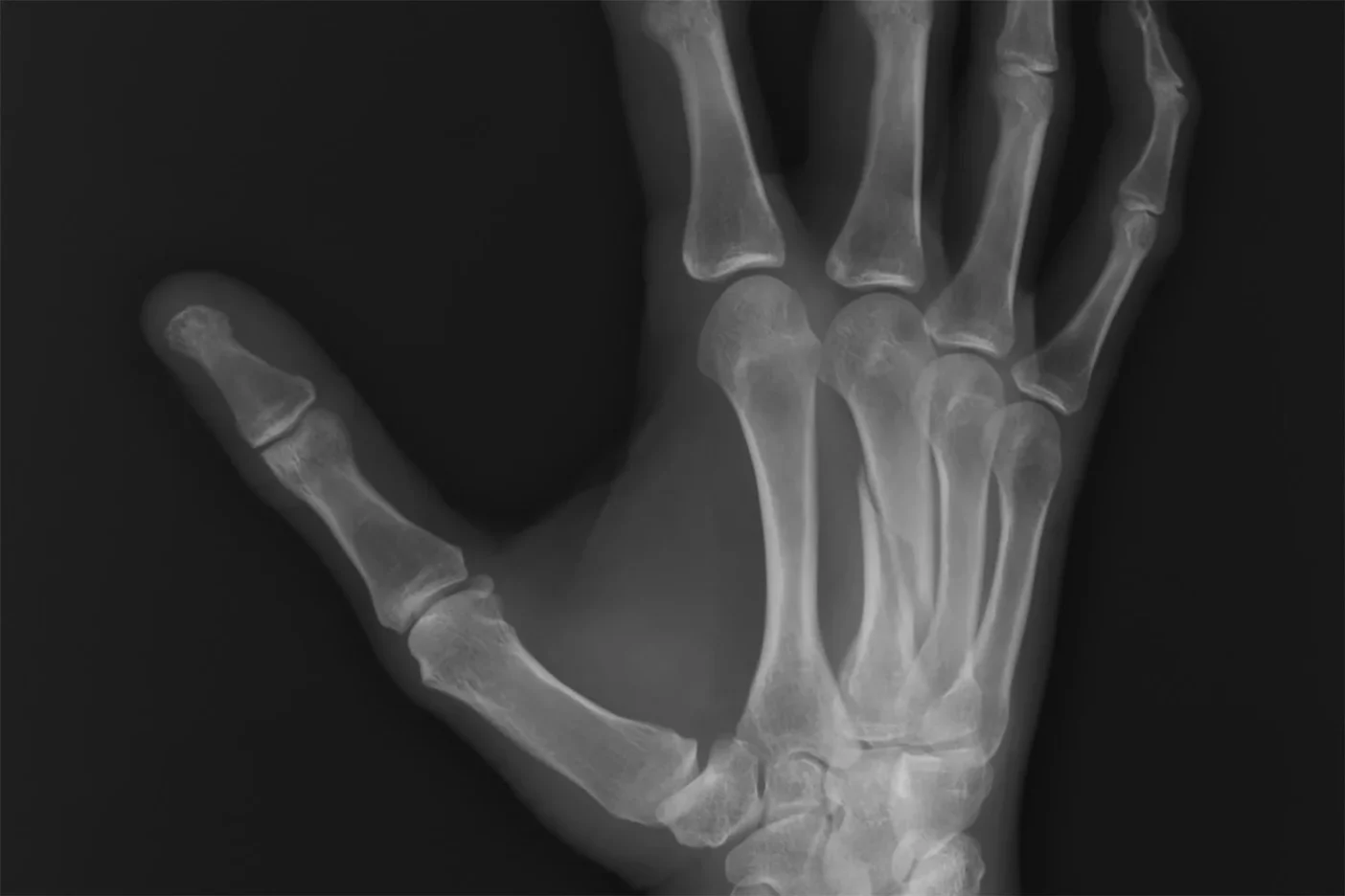 x-ray of broken metacarpal bone
